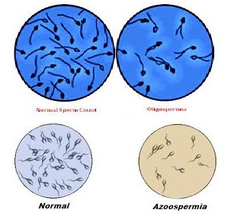 Oligospermia / Azoospermia